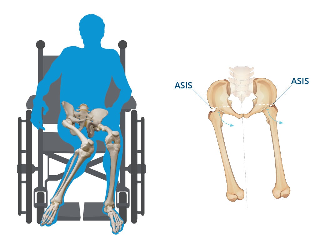 Windswept Posture Symptoms and treatment through wheelchair positioning
